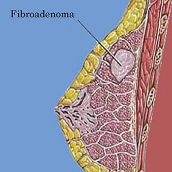 Фиброаденома 